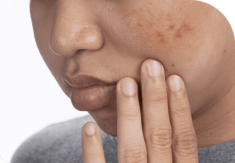 Neogen Plasma 117 Even Skin Tone with Neogen Plasma Treatment in Leeds