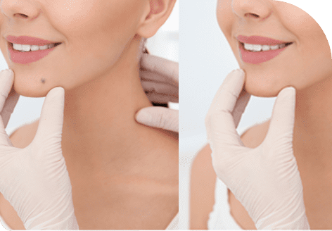 Improved Appearance with Mole Removal Treatment in Leeds