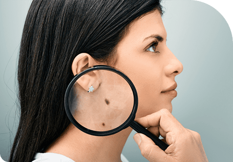 Improved Skin Texture with Mole Removal Treatment in Leeds