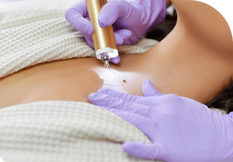 Increased Clothing Options with Mole Removal Treatment in Leeds