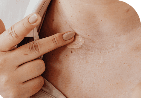 Neogen Plasma 115 Scar Improvement with Neogen Plasma Treatment in Leeds