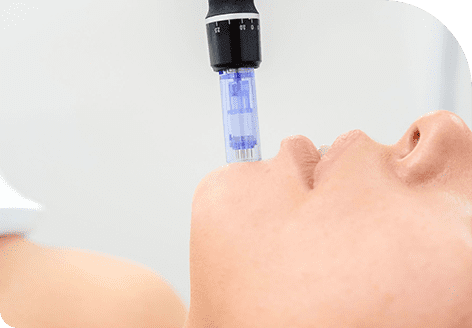 Forehead Lines 40 Scar Improvement with SkinPen Microneeding in Leeds