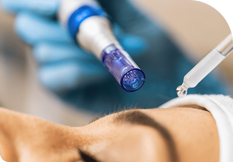 SkinPen Microneedling 172 Pigmentation Correction with SkinPen Microneeding in Leeds