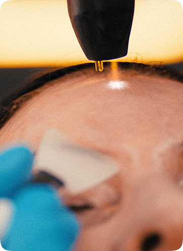 Neogen Plasma 90 Neogen Plasma Treatment in Leeds, UK