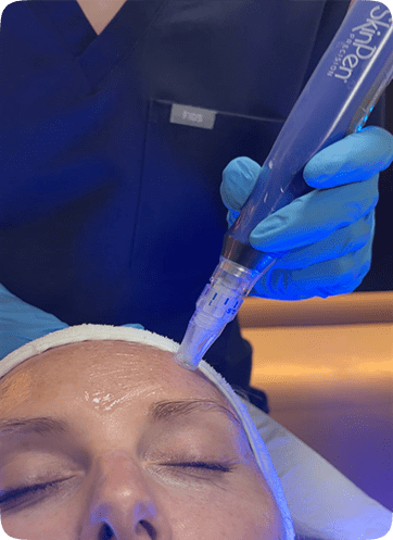 SkinPen Microneedling 155 SkinPen Microneeding Treatment in Leeds