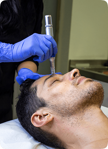 SkinPen Microneedling 154 SkinPen Microneeding Treatment in Leeds