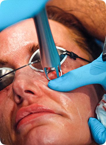 Skin Resurfacing Treatment with Ultraclear in Leeds​