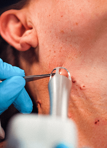 Skin Resurfacing Treatment with Ultraclear in Leeds​