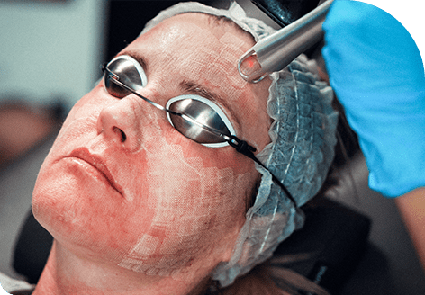 Improved Texture and Tone with Morpheus8 Treatment in Leeds​