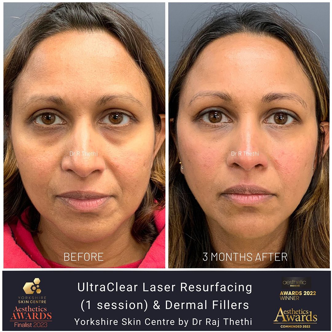 Skin Resurfacing Before and After Images