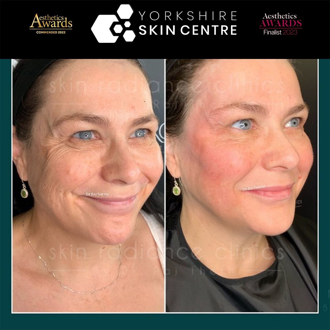 Thermavein Before and After Images