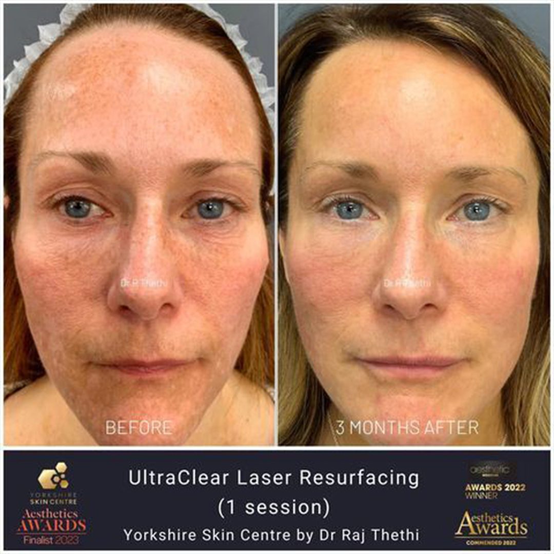 Skin Resurfacing Before and After Images