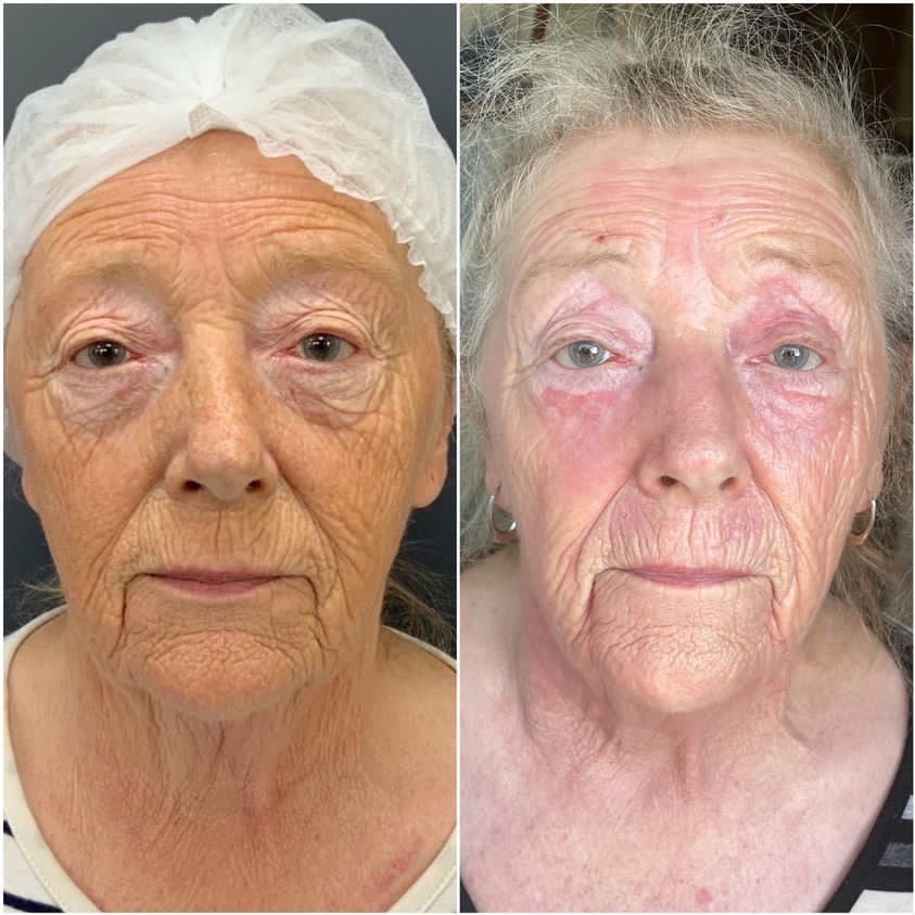 Forehead Lines 50 Neogen - Wrinkle and fine lines , creepy skin