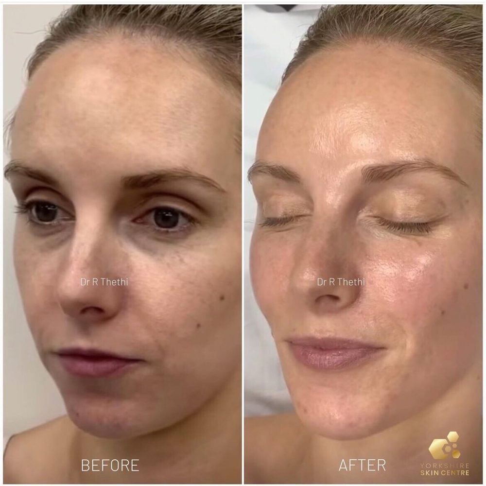Chemical Peel Before and After Images