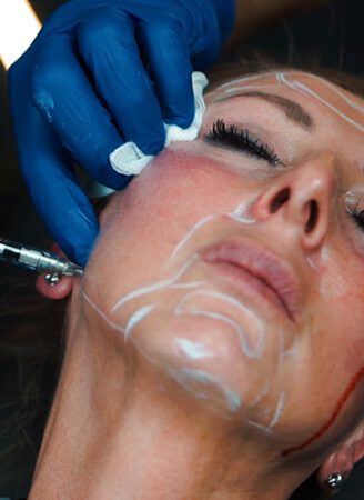 Dermal Fillers 144 Dermal Fillers in Leeds