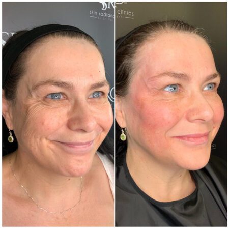 Dermal Fillers 155 Dermal Fillers Before and After Images