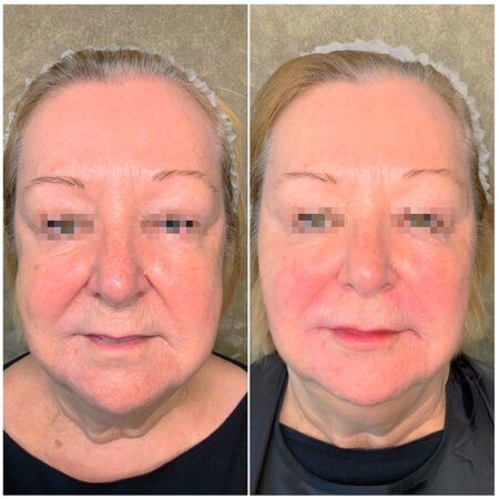 Dermal Fillers 154 Dermal Fillers Before and After Images