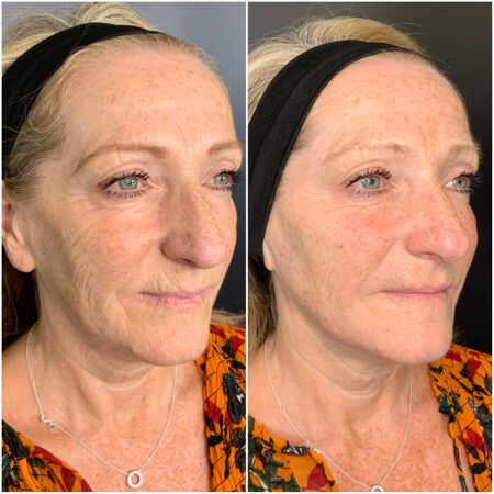 Dermal Fillers 153 Dermal Fillers Before and After Images