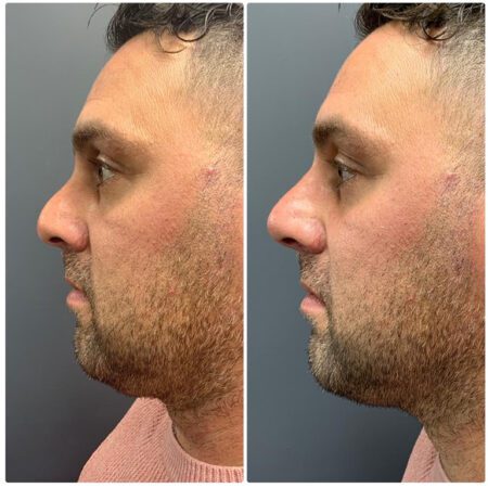 Dermal Fillers 152 Dermal Fillers Before and After Images