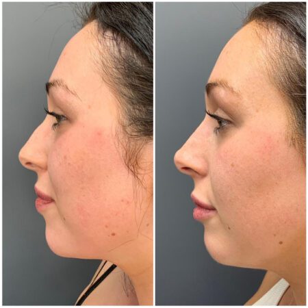 Dermal Fillers 151 DermalFillerBF6