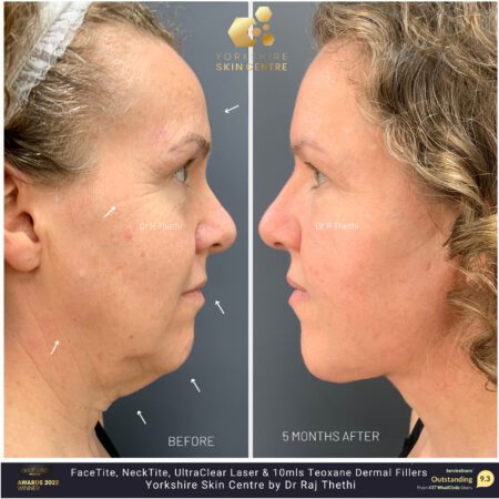 Anti Wrinkle Consultation for Men 116 FaceTite Before and After Images