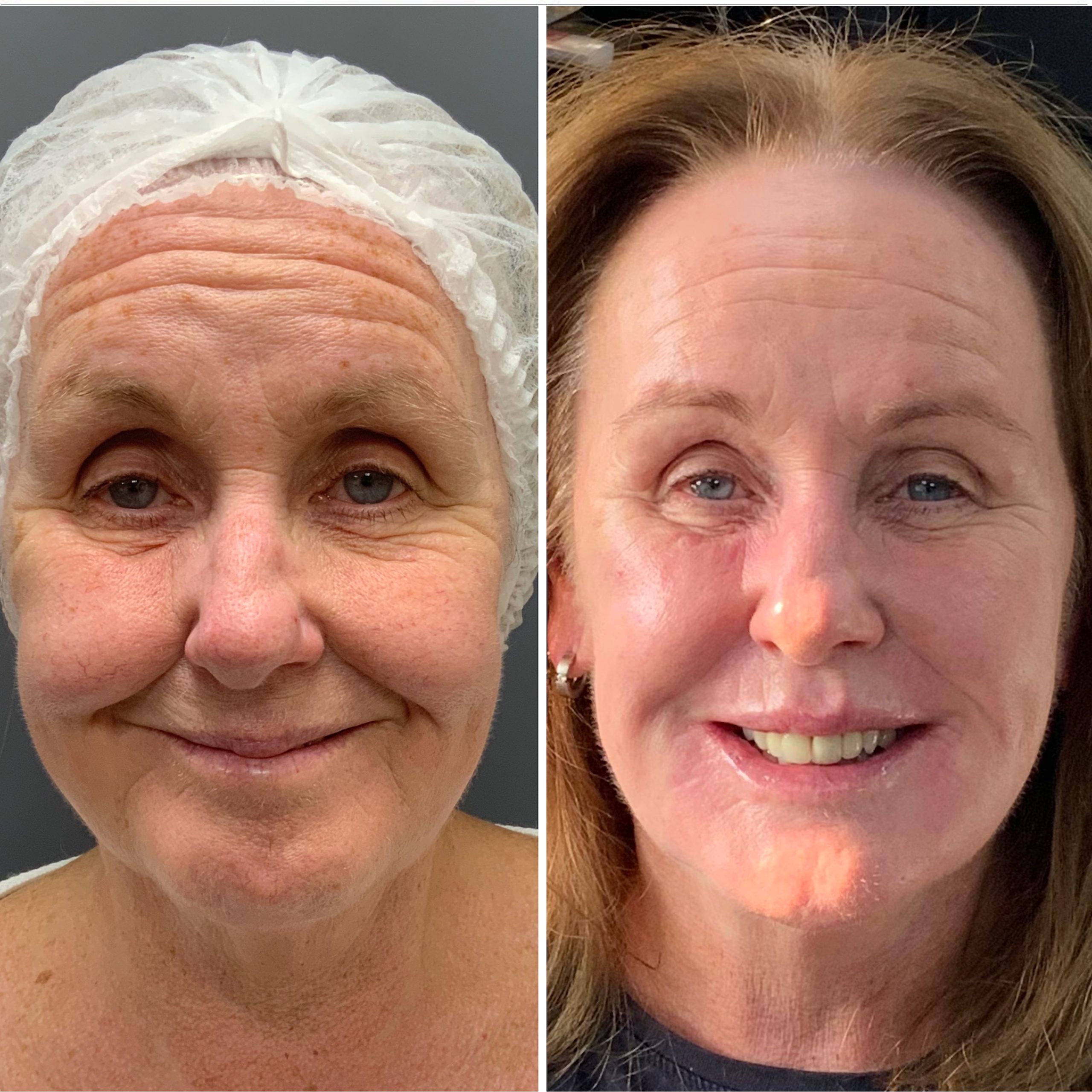 FaceTite Before and After Images