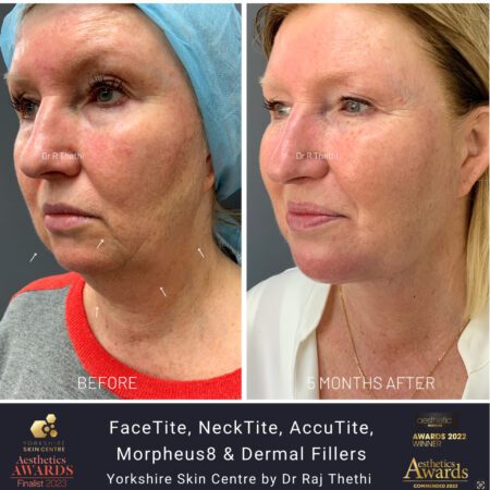 Anti Wrinkle Consultation for Men 119 FaceTite Before and After Images