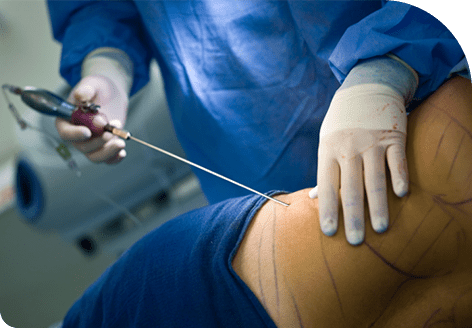 Improved body contour with Liposuction Treatment in Leeds