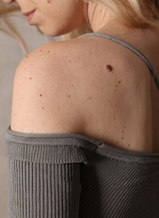 Mole Removal Treatment in Leeds