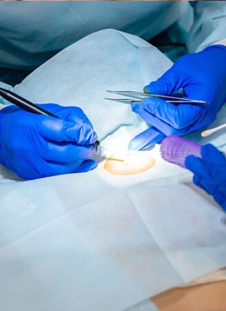 Mole Removal Treatment in Leeds