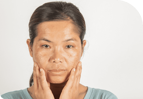 Reduction of sun damage with Lumecca in Leeds