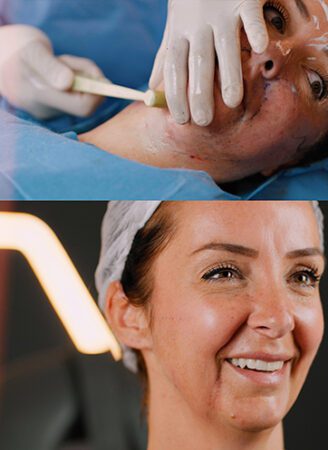 FaceTite Treatment in Leeds​