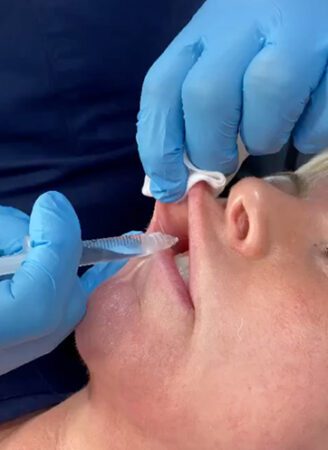 Lip Fillers in Leeds