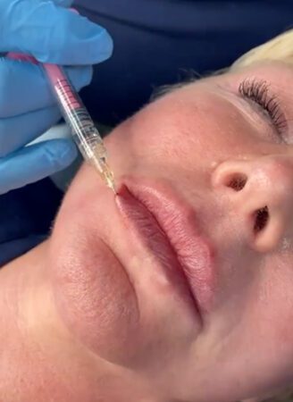 Lip Fillers Treatment in Leeds​