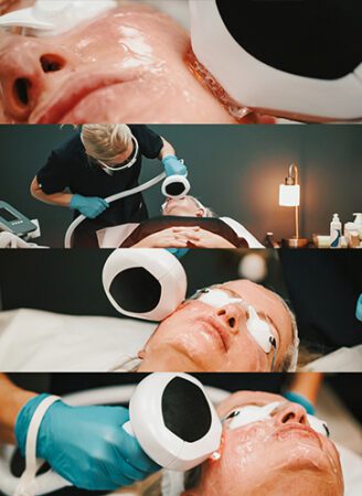 Pigmentation Treatment with Lumecca in Leeds​