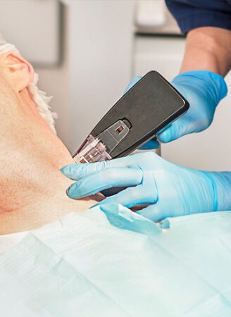 Morpheus8 50 Morpheus8 Treatment in Leeds