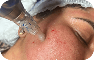 Neogen Plasma Treatment In Leeds