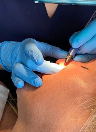 ThermaVein 46 Thermavein Treatment in Leeds