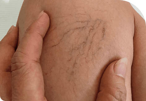 ThermaVein 61 Effectiveness with Thermavein Treatment in Leeds
