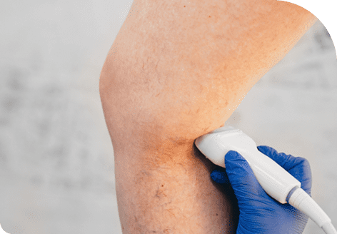 ThermaVein 62 Effectiveness with Thermavein Treatment in Leeds