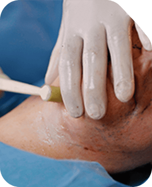 FaceTite treatment Image