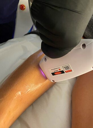 Laser Hair Removal Treatment with PermaICE in Leeds​