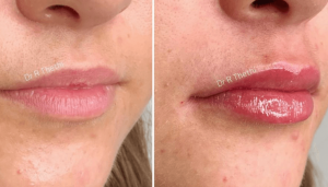 0.5 ml Lip Filler Before and After