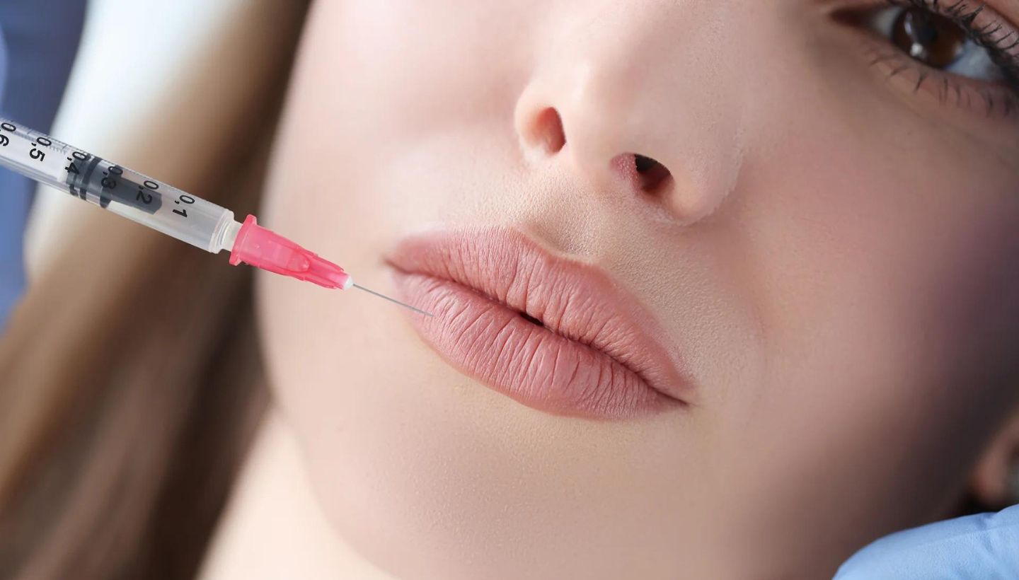 Mastering the 1 ml Russian Lip Filler Technique