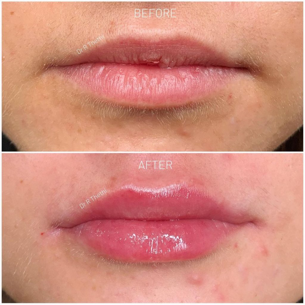 1ml RHA3. Premium quality filler from Teoxane