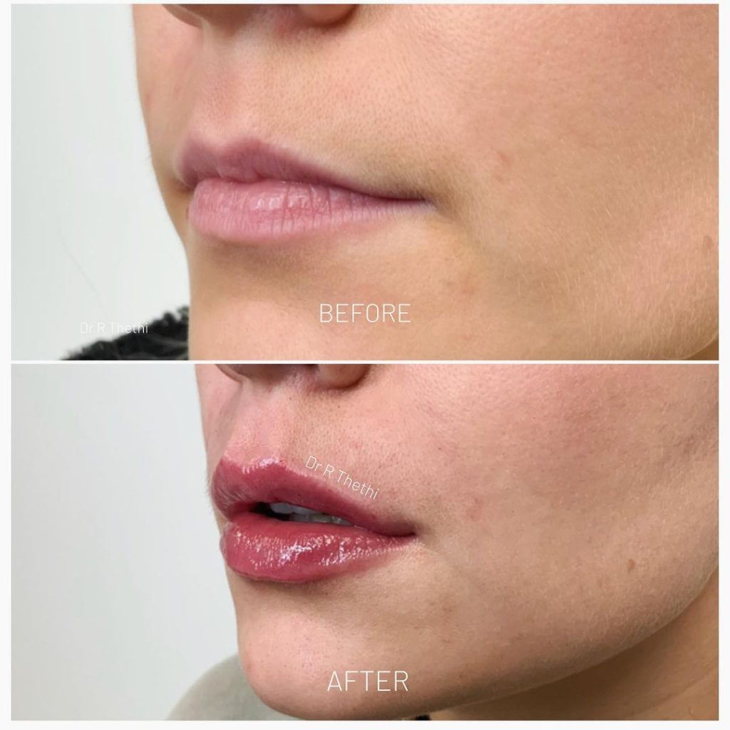 1ml teoxane lip filler before and after result