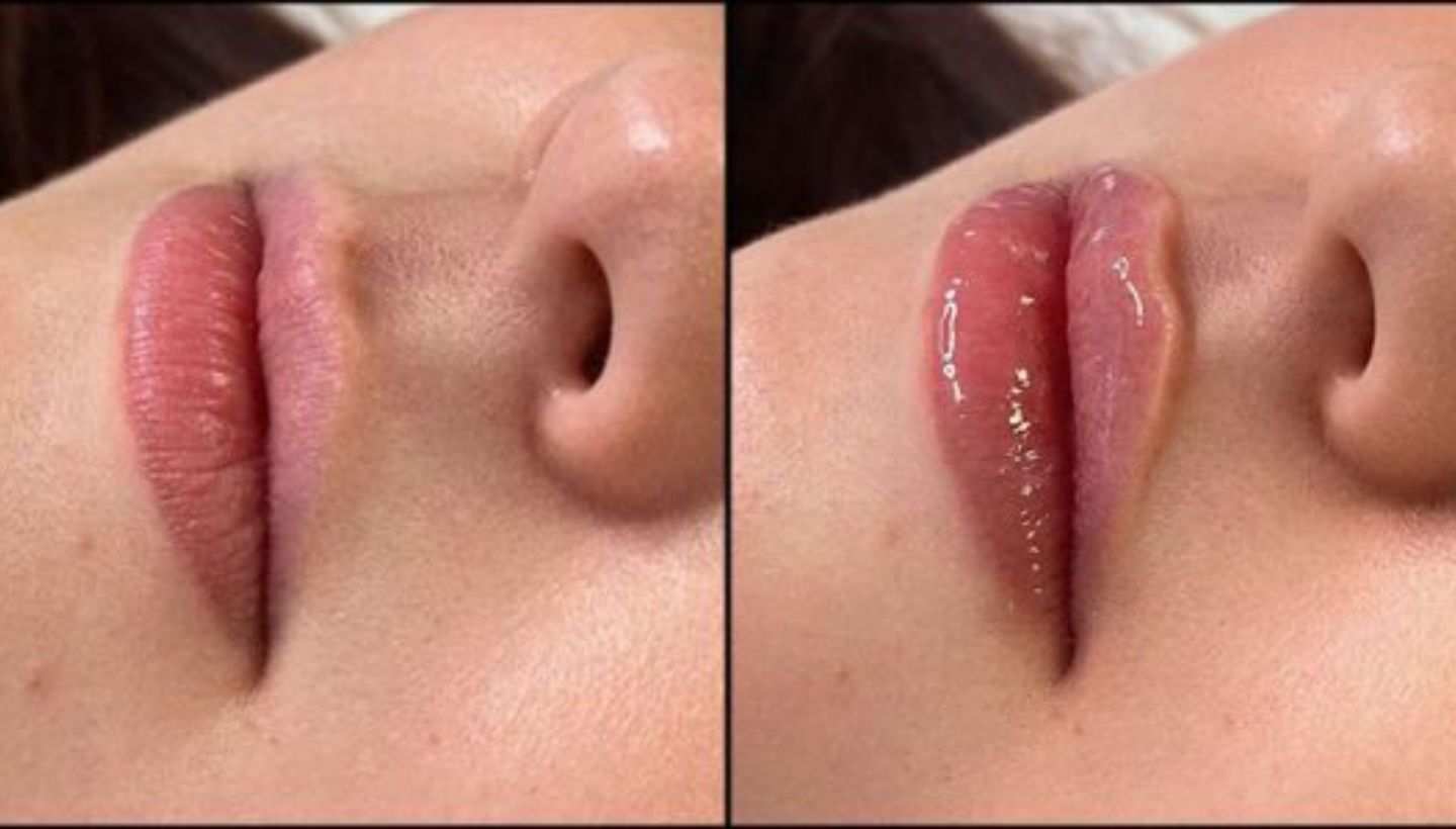 Before and After Thin Lip Russian Lip Filler