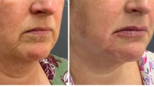 How Long Does 0.5 ml Lip Filler Last?