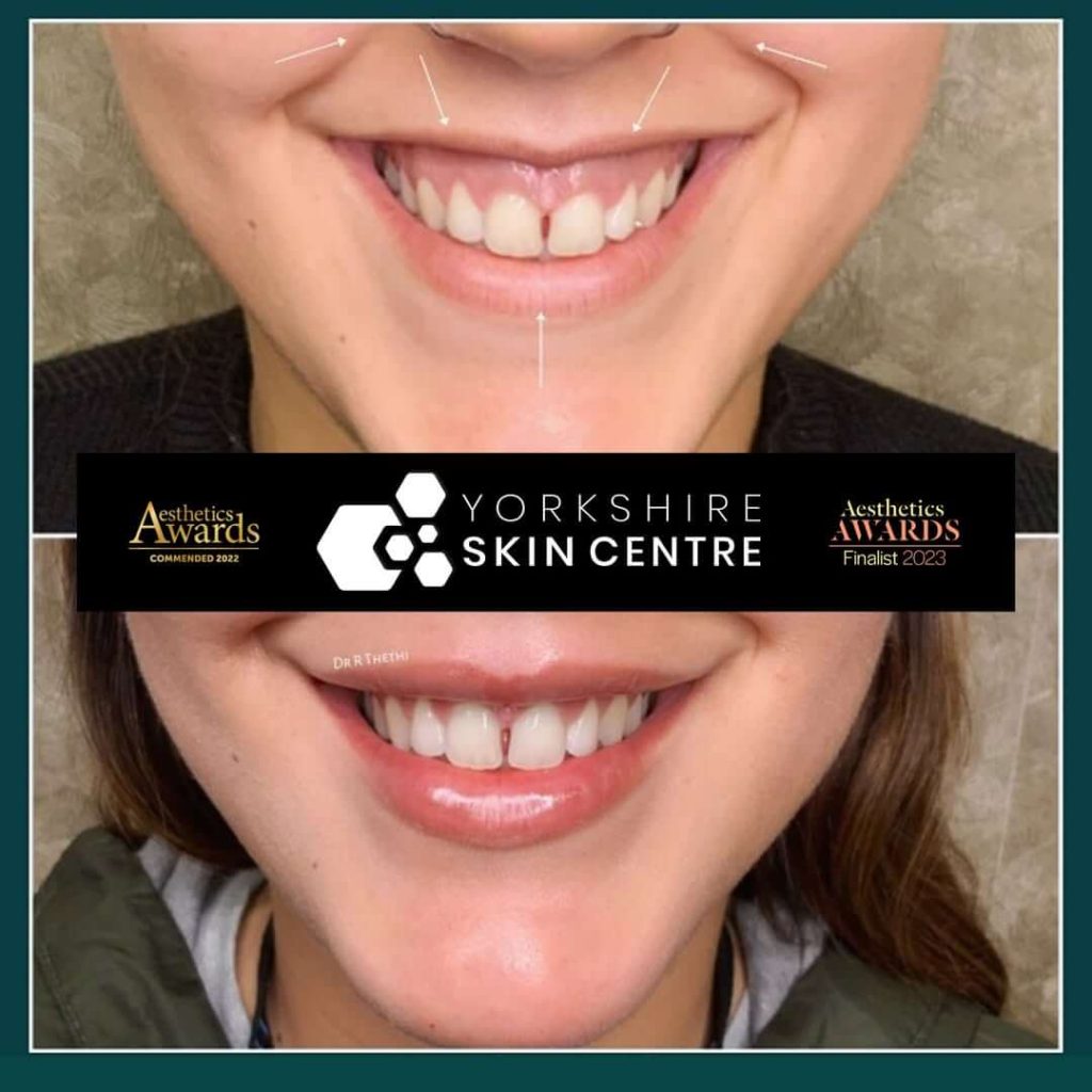 Lip filler treatment results by Dr Raj