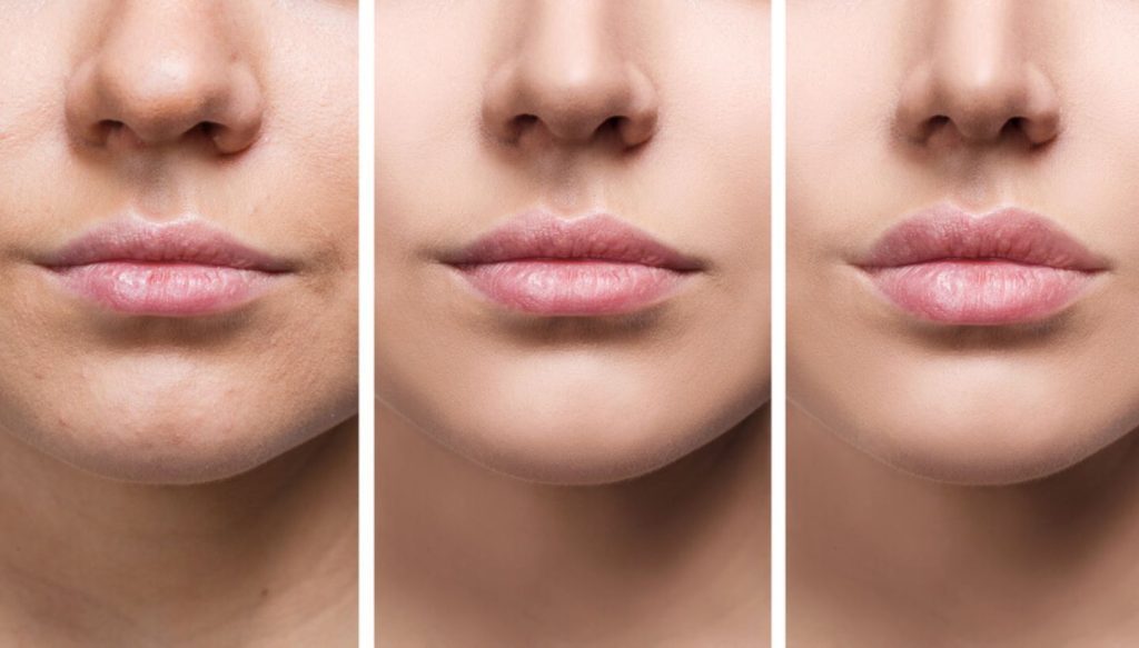 Russian Lip Filler Healing Process: Timeline and Tips